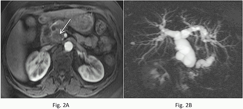Figure 2A- 2B Pancreatic adenocarcinoma arising in the head. Transverse immediate post-contrast fat-suppressed T1-weighted 3D-GE (A) and coronal oblique thick-section MRCP (B) images. On immediate postcontrast image (A), the tumor is well shown as a low signal intensity mass (arrow). The MRCP image (B) demonstrates obstruction of the common bile duct and pancreatic duct, creating the double duct sign.