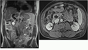 Figure 4: Side-branch type IPMT. Coronal T2-weighted single shot echo trains spin echo (A) and axial post-gadolinium fat-suppressed T1-weighted gradient echo (B) images demonstrate mainly large cystic side branch lesion in the head of the pancreas (arrow).
